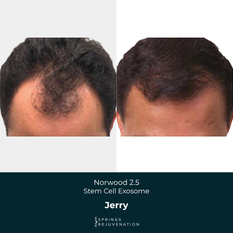 Jerry - Before & After